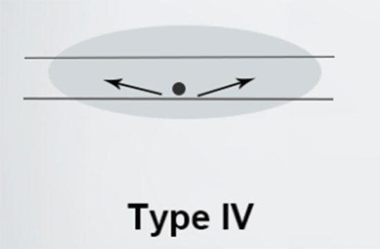 Type IV Type IV