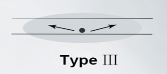 Type III Type III
