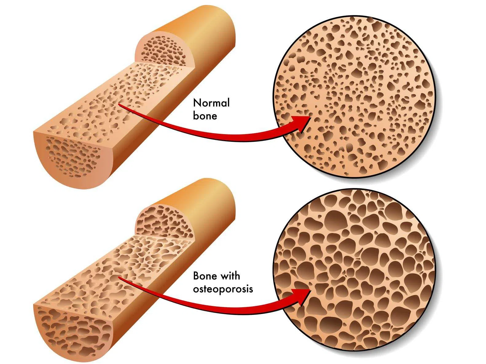 bone with osteoporosis